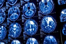 MRI Brain Tumor Detection